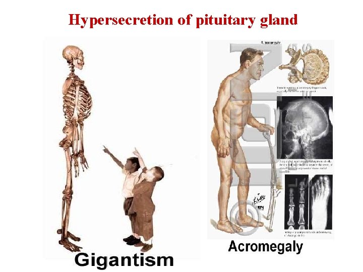 Hypersecretion of pituitary gland 