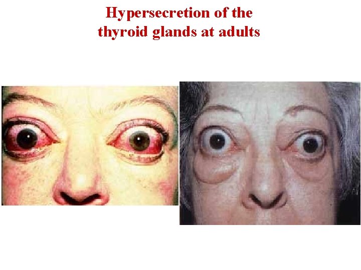 Hypersecretion of the thyroid glands at adults 