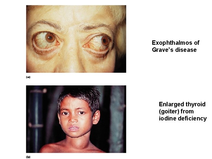 Exophthalmos of Grave’s disease Enlarged thyroid (goiter) from iodine deficiency 