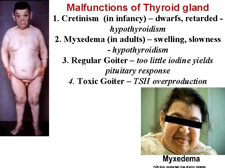 Malfunctions of Thyroid gland 1. Cretinism (in infancy) – dwarfs, retarded hypothyroidism 2. Myxedema