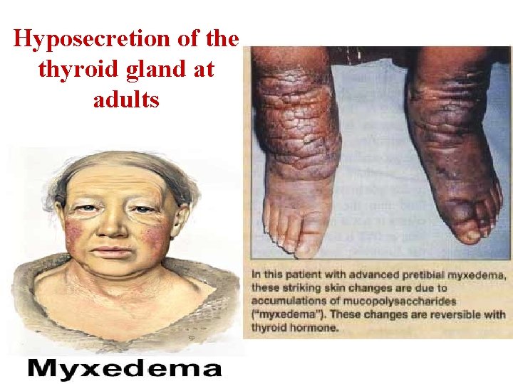 Hyposecretion of the thyroid gland at adults 