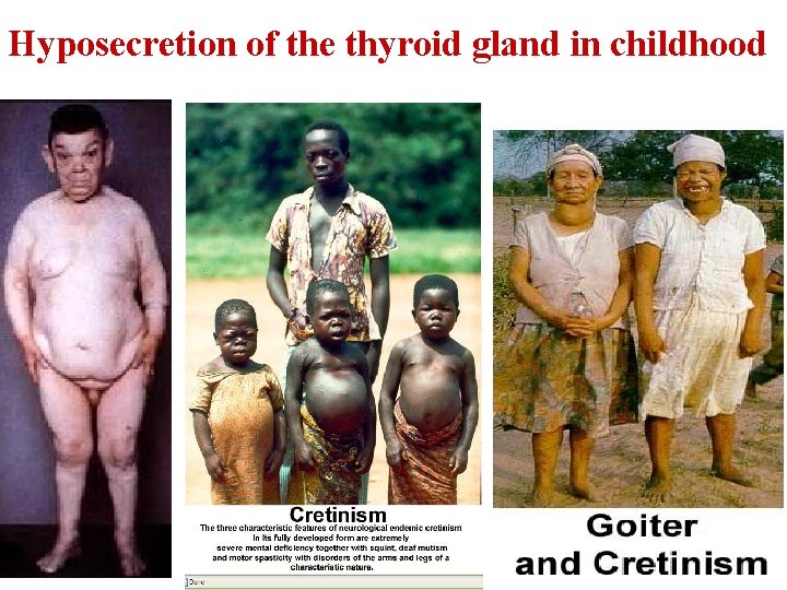 Hyposecretion of the thyroid gland in childhood 