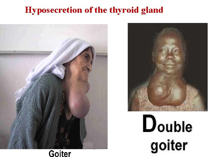 Hyposecretion of the thyroid gland 