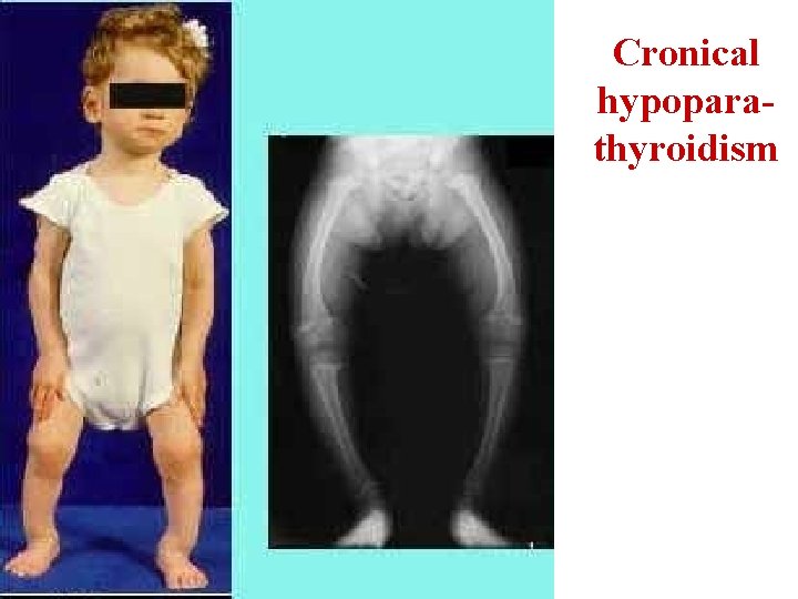 Cronical hypoparathyroidism 