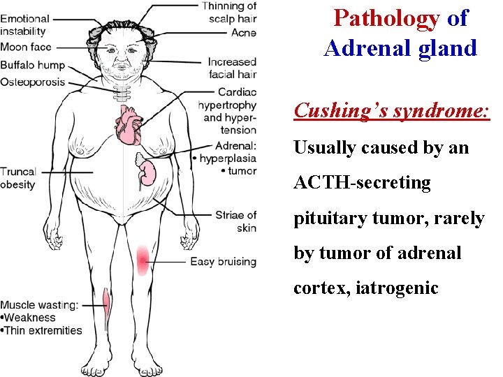 Pathology of Adrenal gland Cushing’s syndrome: Usually caused by an ACTH-secreting pituitary tumor, rarely