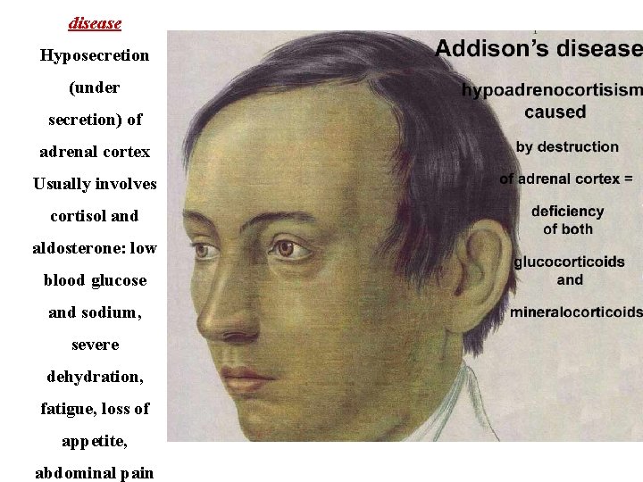 disease Hyposecretion (under secretion) of adrenal cortex Usually involves cortisol and aldosterone: low blood