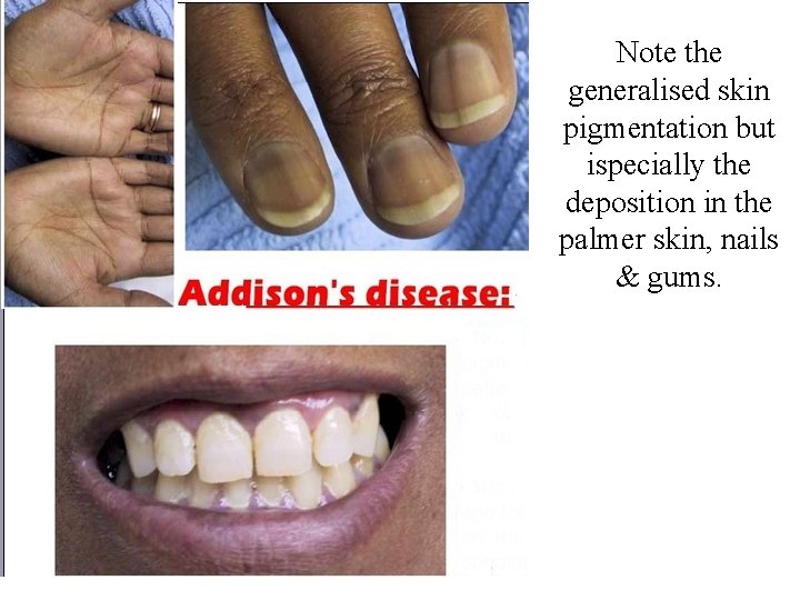 Note the generalised skin pigmentation but ispecially the deposition in the palmer skin, nails