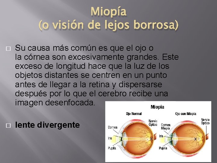 Miopía (o visión de lejos borrosa) � Su causa más común es que el Miopía (o visión de lejos borrosa) � Su causa más común es que el