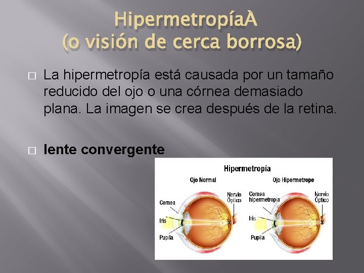 Hipermetropía (o visión de cerca borrosa) � La hipermetropía está causada por un tamaño Hipermetropía (o visión de cerca borrosa) � La hipermetropía está causada por un tamaño
