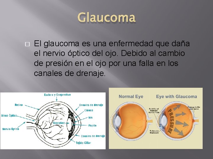 Glaucoma � El glaucoma es una enfermedad que daña el nervio óptico del ojo. Glaucoma � El glaucoma es una enfermedad que daña el nervio óptico del ojo.