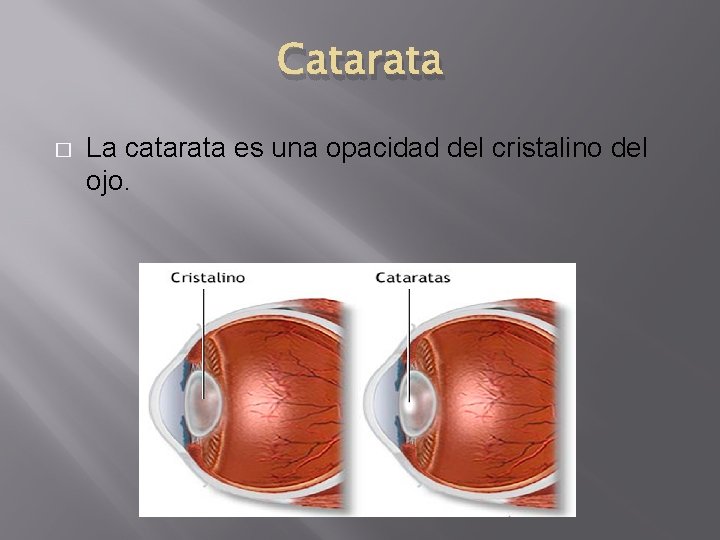 Catarata � La catarata es una opacidad del cristalino del ojo. Catarata � La catarata es una opacidad del cristalino del ojo.