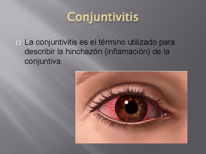 Conjuntivitis � La conjuntivitis es el término utilizado para describir la hinchazón (inflamación) de Conjuntivitis � La conjuntivitis es el término utilizado para describir la hinchazón (inflamación) de