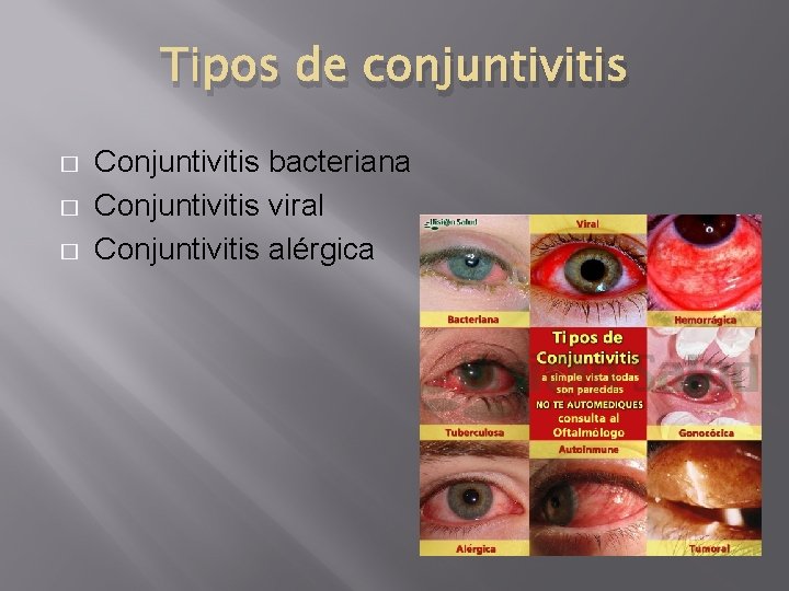 Tipos de conjuntivitis � � � Conjuntivitis bacteriana Conjuntivitis viral Conjuntivitis alérgica Tipos de conjuntivitis � � � Conjuntivitis bacteriana Conjuntivitis viral Conjuntivitis alérgica