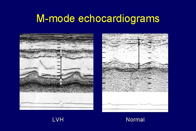 M-mode echocardiograms LVH Normal 