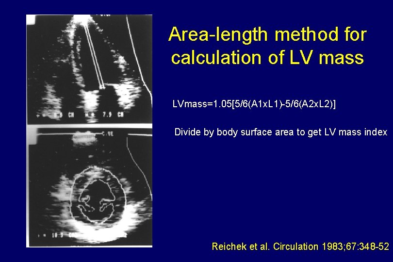 Area-length method for calculation of LV mass LVmass=1. 05[5/6(A 1 x. L 1)-5/6(A 2