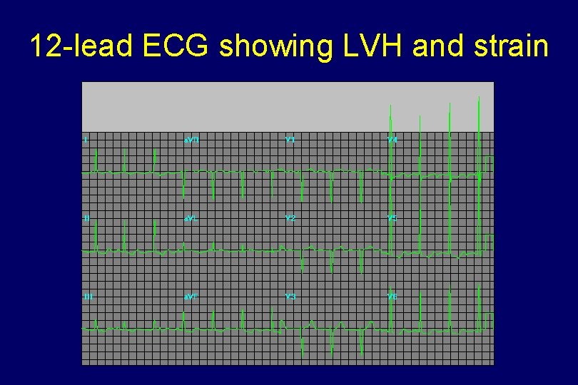 12 -lead ECG showing LVH and strain 