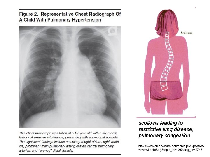 scoliosis leading to restrictive lung disease, pulmonary congestion http: //www. ebmedicine. net/topics. php? paction