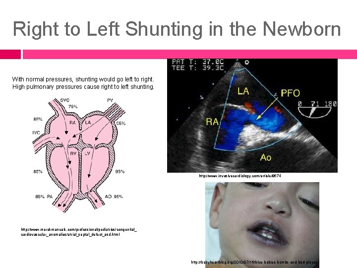 Right to Left Shunting in the Newborn With normal pressures, shunting would go left