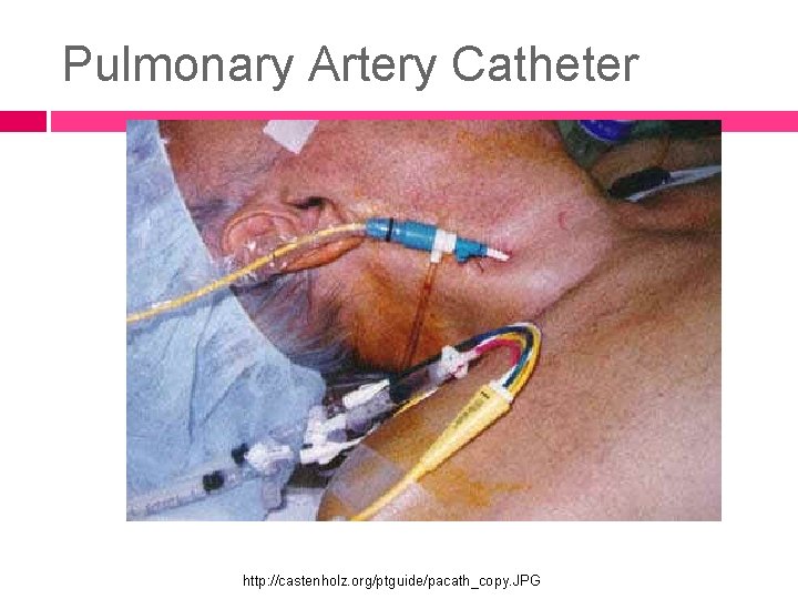 Pulmonary Artery Catheter http: //castenholz. org/ptguide/pacath_copy. JPG 