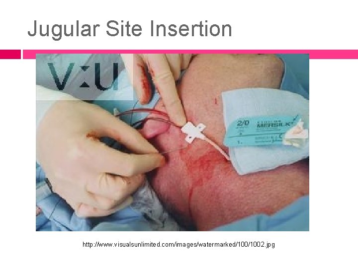 Jugular Site Insertion http: //www. visualsunlimited. com/images/watermarked/1002. jpg 