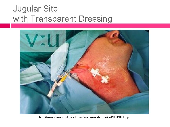 Jugular Site with Transparent Dressing http: //www. visualsunlimited. com/images/watermarked/1000. jpg 