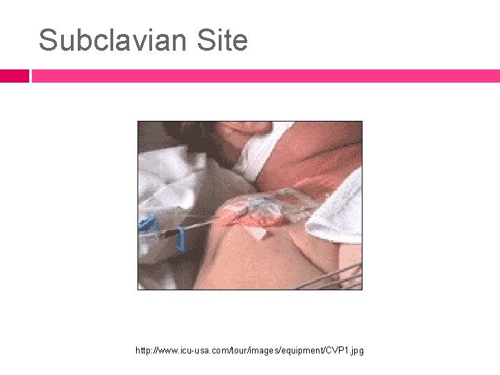 Subclavian Site http: //www. icu-usa. com/tour/images/equipment/CVP 1. jpg 