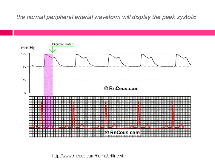 the normal peripheral arterial waveform will display the peak systolic http: //www. rnceus. com/hemo/artline.