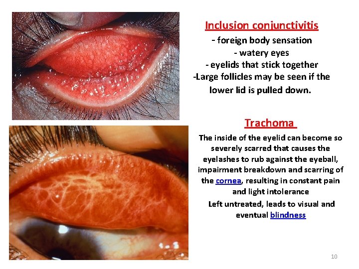 Inclusion conjunctivitis - foreign body sensation - watery eyes - eyelids that stick together