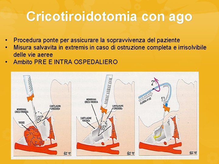 Cricotiroidotomia con ago • Procedura ponte per assicurare la sopravvivenza del paziente • Misura