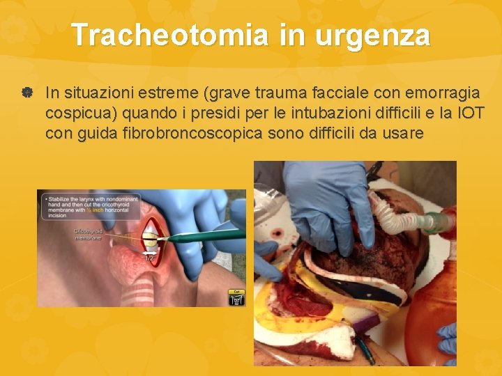 Tracheotomia in urgenza In situazioni estreme (grave trauma facciale con emorragia cospicua) quando i