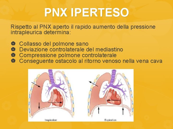 PNX IPERTESO Rispetto al PNX aperto il rapido aumento della pressione intrapleurica determina: Collasso