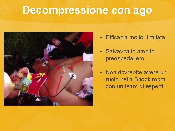 Decompressione con ago • Efficacia molto limitata • Salvavita in ambito preospedaliero • Non