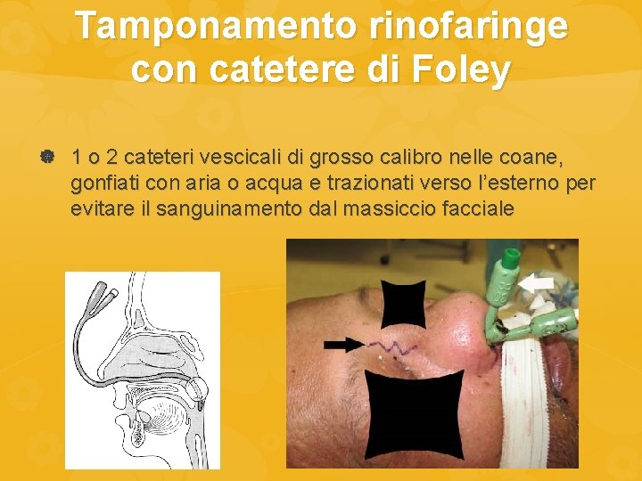 Tamponamento rinofaringe con catetere di Foley 1 o 2 cateteri vescicali di grosso calibro