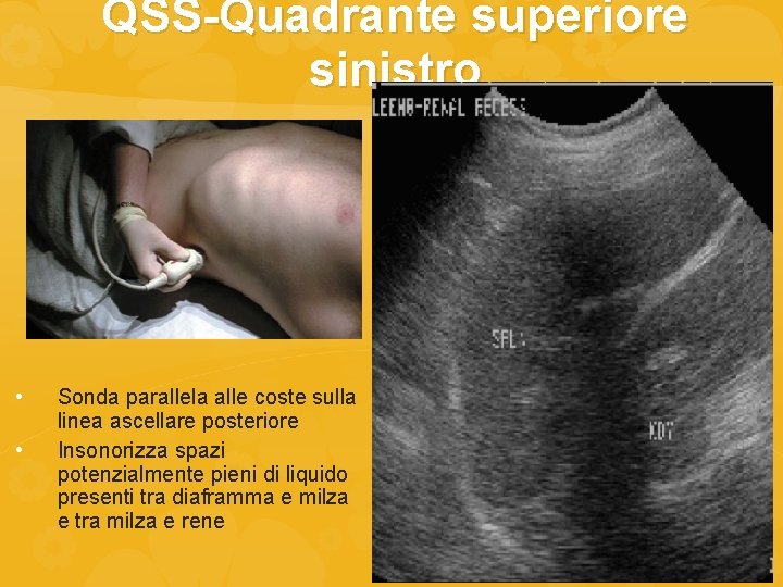 QSS-Quadrante superiore sinistro • • Sonda parallela alle coste sulla linea ascellare posteriore Insonorizza