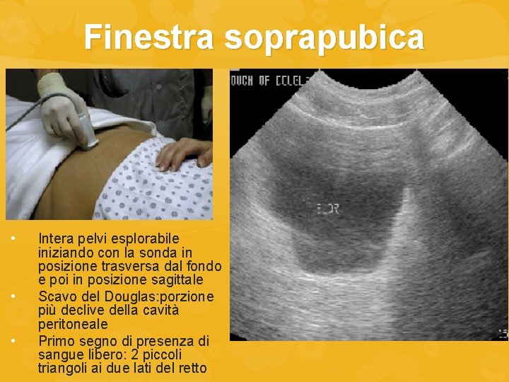 Finestra soprapubica • • • Intera pelvi esplorabile iniziando con la sonda in posizione