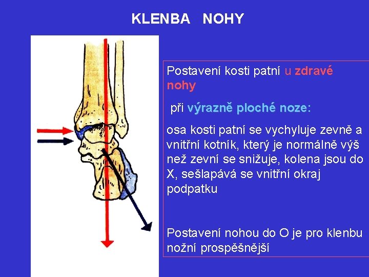 KLENBA NOHY Postavení kosti patní u zdravé nohy při výrazně ploché noze: noze osa