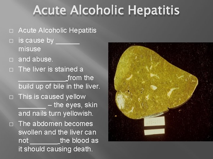 Acute Alcoholic Hepatitis � � � Acute Alcoholic Hepatitis is cause by ______ misuse