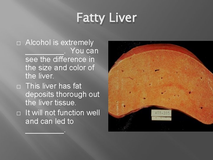 Fatty Liver � � � Alcohol is extremely _____. You can see the difference