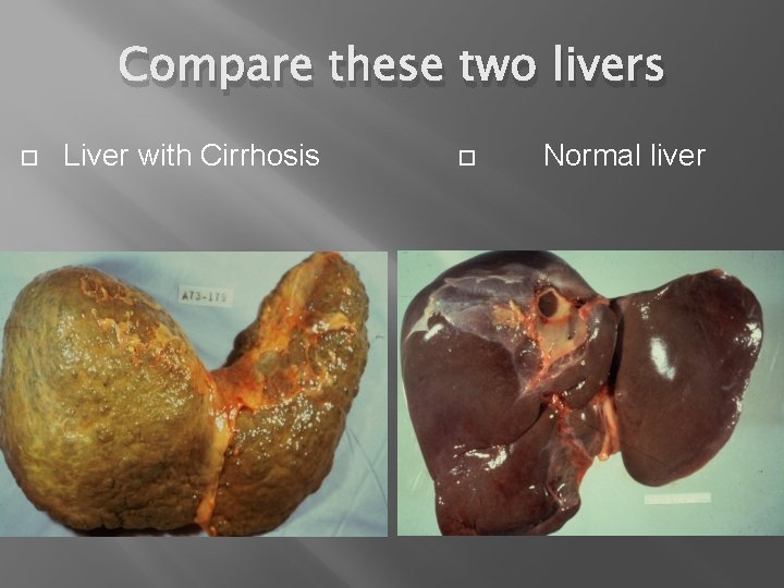 Compare these two livers Liver with Cirrhosis Normal liver 