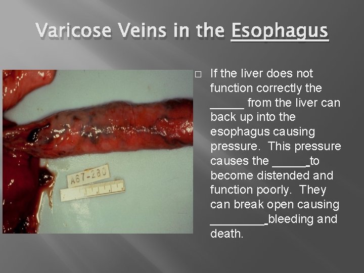 Varicose Veins in the Esophagus � If the liver does not function correctly the