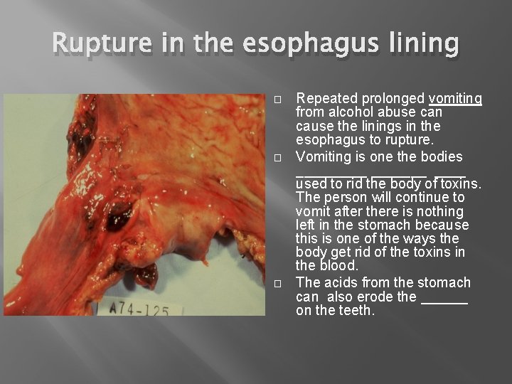Rupture in the esophagus lining � � � Repeated prolonged vomiting from alcohol abuse