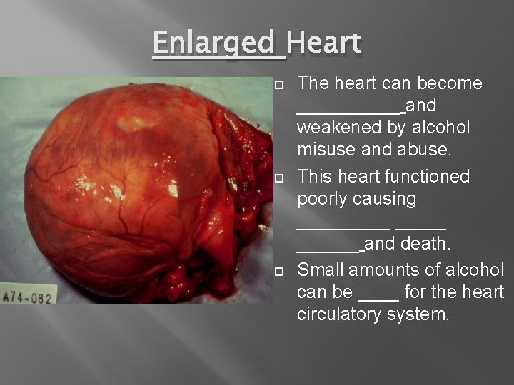 Enlarged Heart The heart can become _____ and weakened by alcohol misuse and abuse.