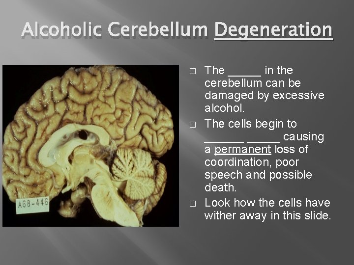 Alcoholic Cerebellum Degeneration � � � The _____ in the cerebellum can be damaged