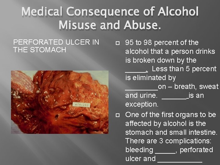 Medical Consequence of Alcohol Misuse and Abuse. PERFORATED ULCER IN THE STOMACH 95 to