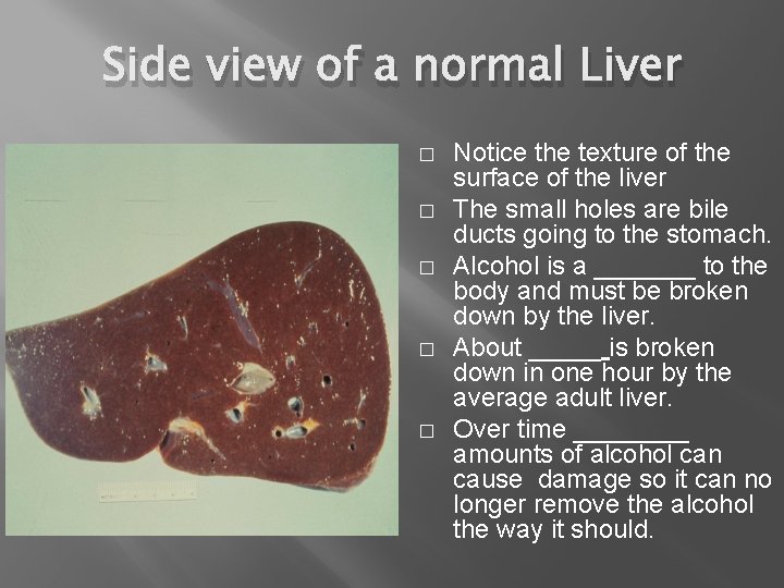 Side view of a normal Liver � � � Notice the texture of the