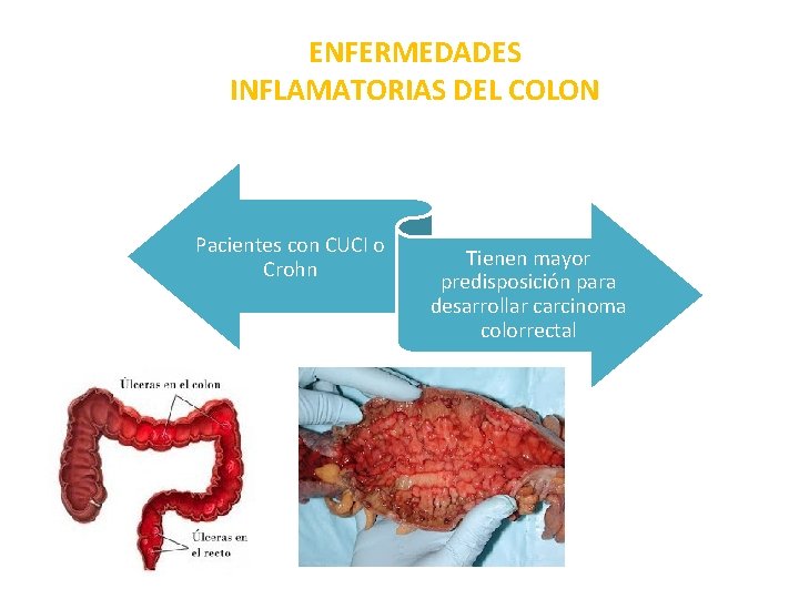 ENFERMEDADES INFLAMATORIAS DEL COLON Pacientes con CUCI o Crohn Tienen mayor predisposición para desarrollar ENFERMEDADES INFLAMATORIAS DEL COLON Pacientes con CUCI o Crohn Tienen mayor predisposición para desarrollar