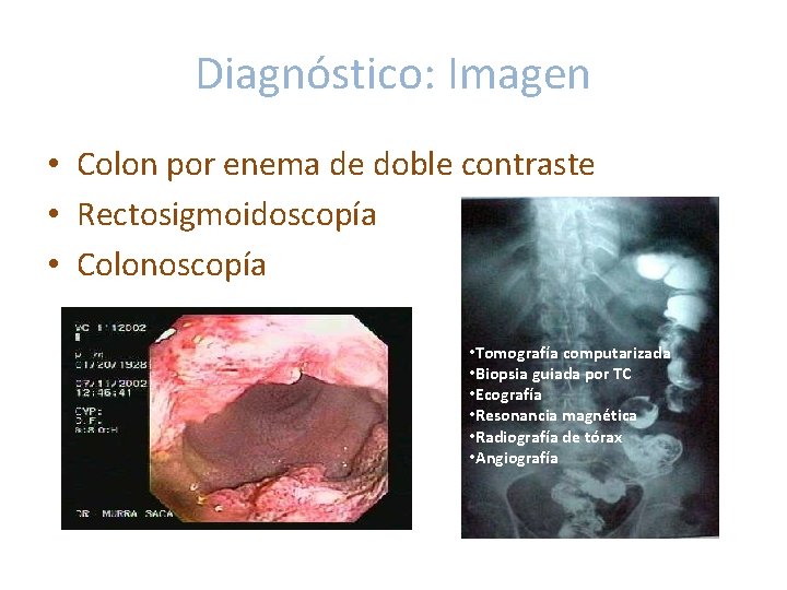 Diagnóstico: Imagen • Colon por enema de doble contraste • Rectosigmoidoscopía • Colonoscopía • Diagnóstico: Imagen • Colon por enema de doble contraste • Rectosigmoidoscopía • Colonoscopía •