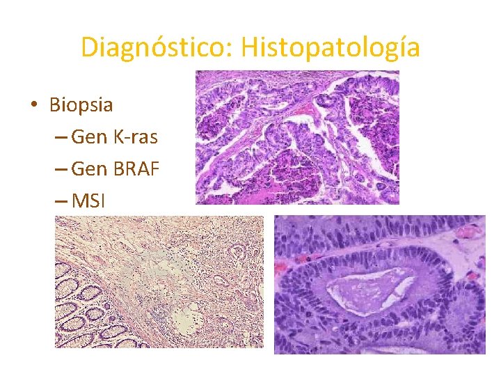 Diagnóstico: Histopatología • Biopsia – Gen K-ras – Gen BRAF – MSI Diagnóstico: Histopatología • Biopsia – Gen K-ras – Gen BRAF – MSI