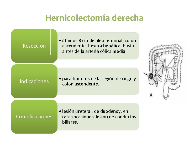 Hernicolectomía derecha Resección • últimos 8 cm del íleo terminal, colon ascendente, flexura hepática, Hernicolectomía derecha Resección • últimos 8 cm del íleo terminal, colon ascendente, flexura hepática,
