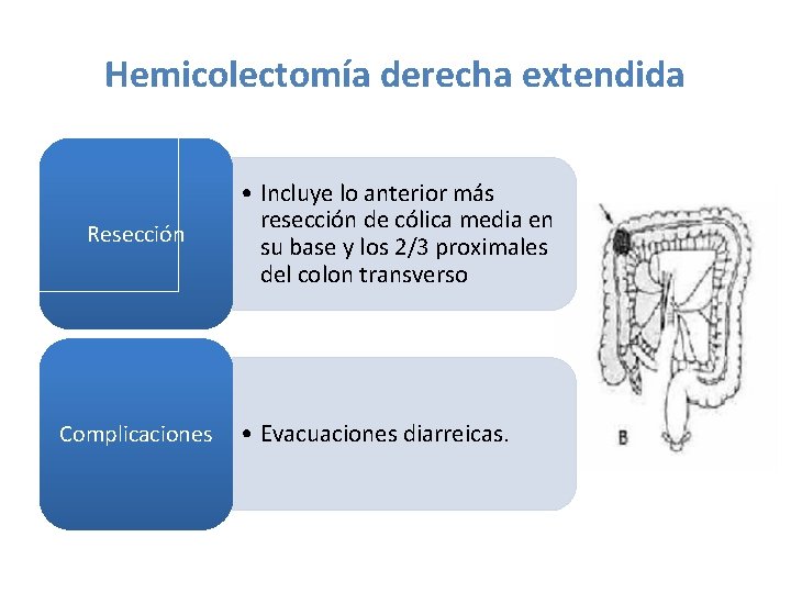 Hemicolectomía derecha extendida Resección Complicaciones • Incluye lo anterior más resección de cólica media Hemicolectomía derecha extendida Resección Complicaciones • Incluye lo anterior más resección de cólica media